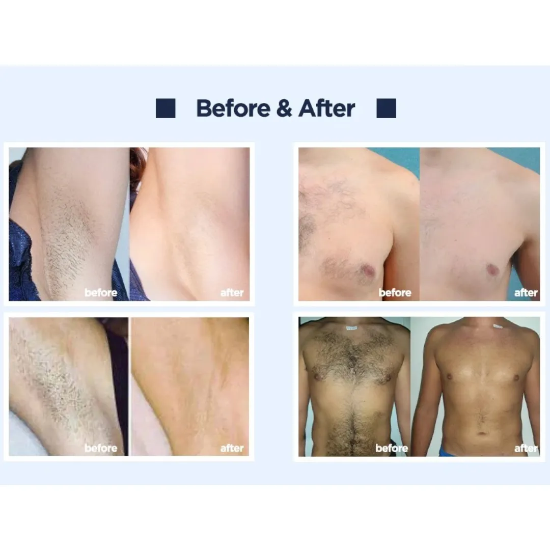 Athena 4D Laser Hair Removal Machine  